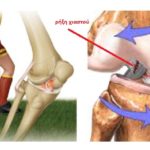 Μηχανισμός ρήξης προσθίου χιαστού