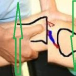 Δοκιμασία Lachman