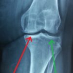 meriki-arthritida-koutsostathis.