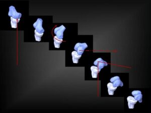 kinimatiki-gonatos-koutsostathis