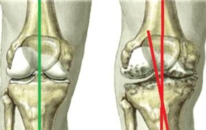 arthitida gonatos koutsostathis