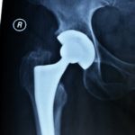 arthroplastiki-isxiou-koutsostathis