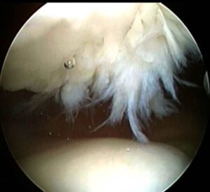 arthritida-epigonatidas-koutsostathis