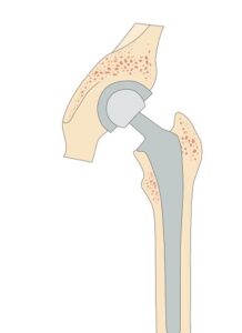 oliki-arthroplastiki-koutsostathis