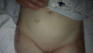 prospelasi-amis-koutsostathis